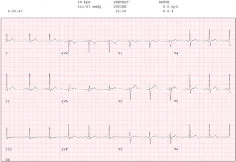 Borderline ECG & Baseline ECG .